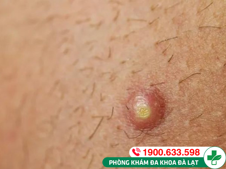 Dương vật nổi mun mủ: Nguyên nhân và phương pháp điều trị
